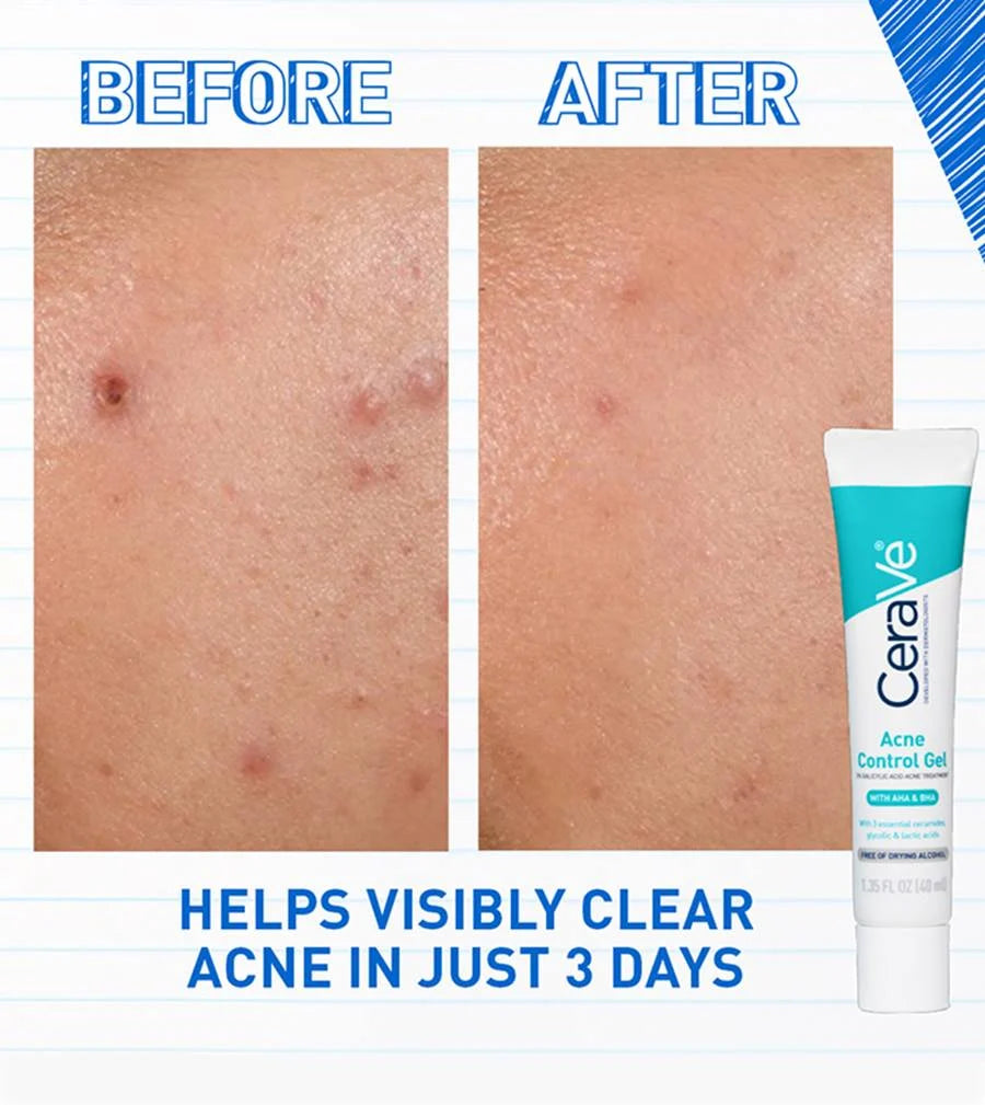 CeraVe Acne Control Gel 1.35 oz (3-Pack) – 2% Salicylic Acid + AHA/BHA for Clearer Skin in 3 Days