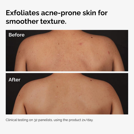 Salicylic Acid 0.5% Body Serum