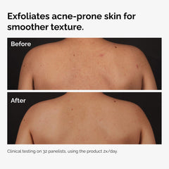 Salicylic Acid 0.5% Body Serum